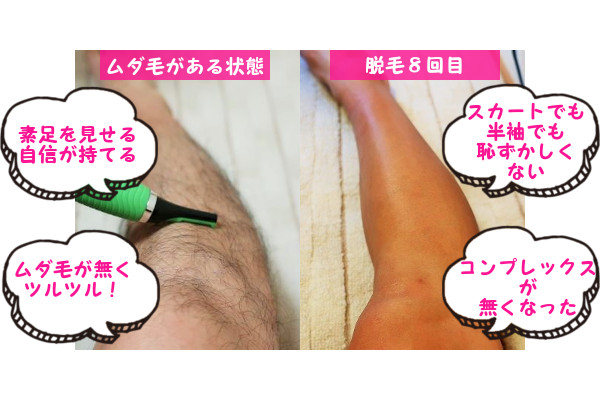 脱毛器ケノンの口コミ・評価っていいけど信じていいの?