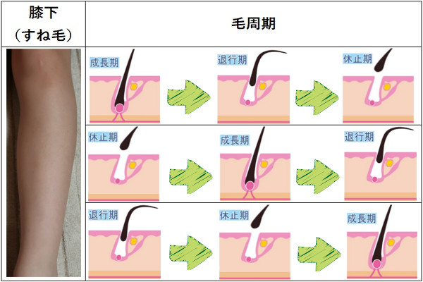 脱毛するときに照射するのは毛周期似合わせるのがコツ