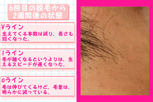 【閲覧注意】ケノンでVIO脱毛！メンズ（男性）の剛毛の効果は？家族に見られずに照射する（画像・写真あり）