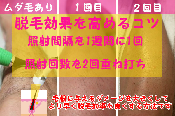 脱毛器ケノンで脱毛効果を上げるコツは2つ！照射間隔と重ね打ち