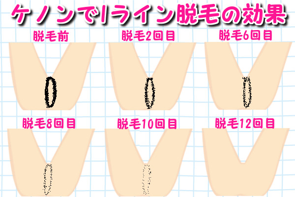 ケノンでIラインを脱毛したときの効果、12回目で完全脱毛完了です