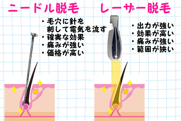 永久脱毛ができるのはレーザー脱毛とニードル脱毛のみ