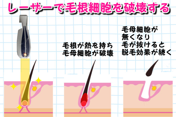 レーザー脱毛とは？メリットとデメリット