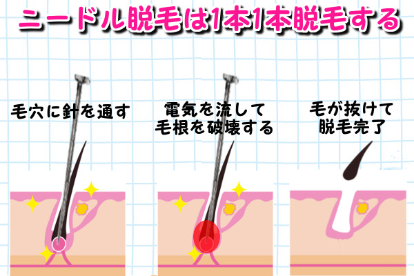 ニードル脱毛は1本1本脱毛していく方法