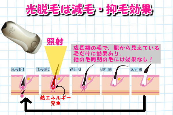 光脱毛は減毛・抑毛効果で永久脱毛ではない