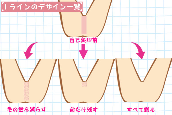 Iラインの毛の形・デザインは3つ