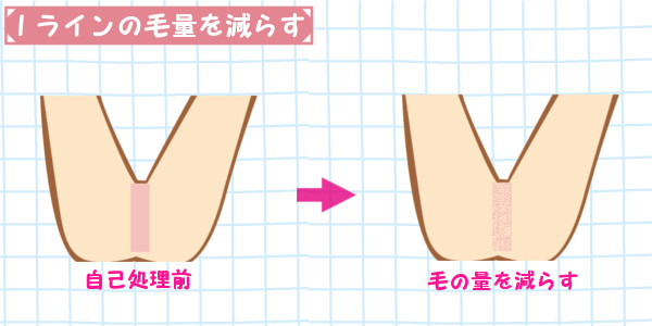 Iラインの自己処理｜毛の量だけを減らす