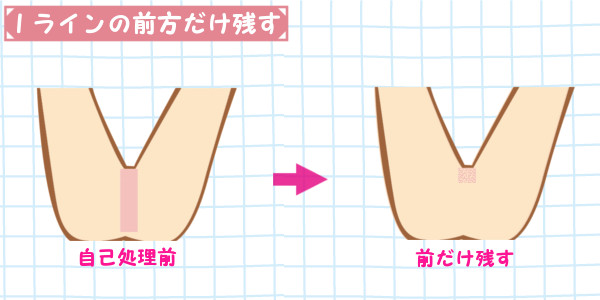 Iラインの自己処理｜前方の毛だけを薄くして残す