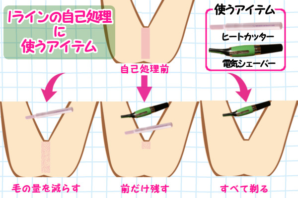 Iラインを自己処理するときに使うアイテムはヒートカッターと電気シェーバー