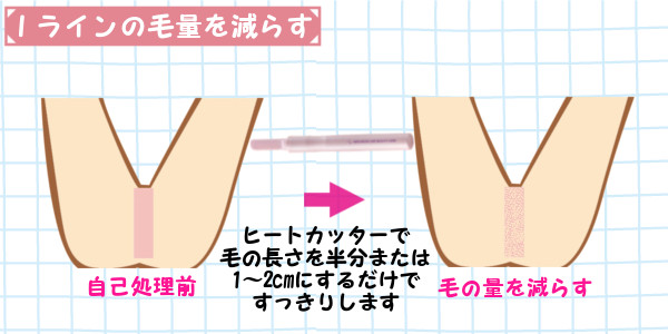 Iラインの毛量を減らすならヒートカッターがおすすめ