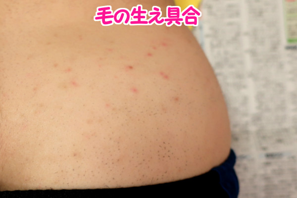 デリーモを使ってみた感想:使い始めて1週間後の毛の生え方