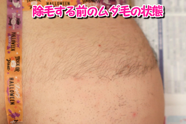 デリーモを使う前のムダ毛の状態