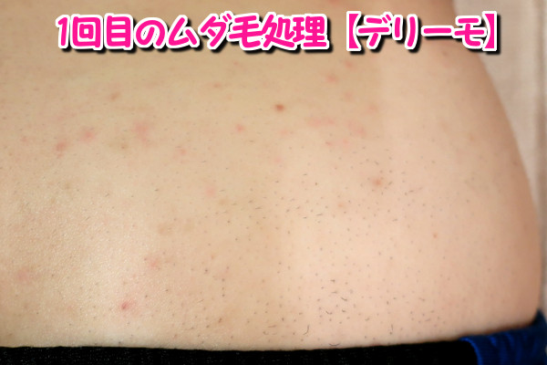 デリーモを使ってみた感想:5日後に毛が生えた