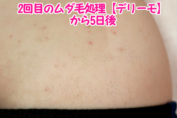 デリーモを使ってみた感想:2回目から5日後の毛の生え方
