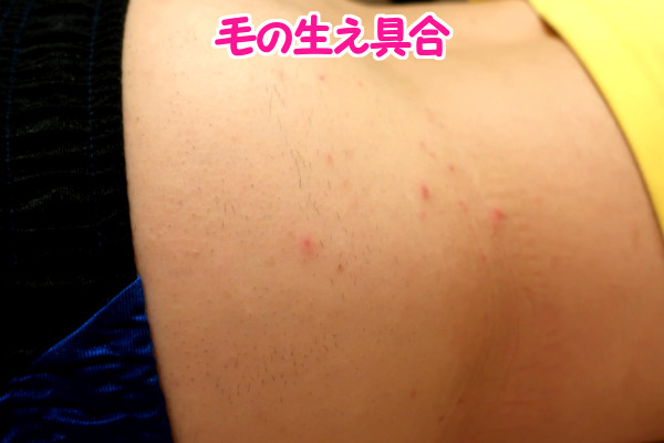 デリーモを使ってみた感想:2回目から1週間後の毛の生え方