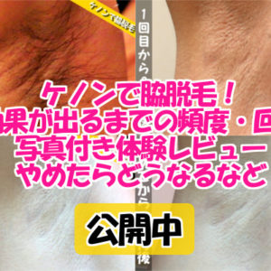 ケノンで脇脱毛した体験談！効果と感想を写真付きで公開中！3ヶ月間脱毛をやめた結果もあるよ