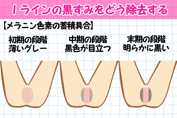 iラインの黒ずみをどう除去する？