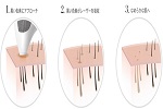 脱毛器ケノンとトリアの脱毛効果・期間の違い