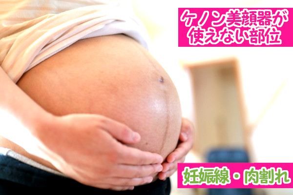 ケノン美顔器が使えない部位！妊娠線・肉割れ