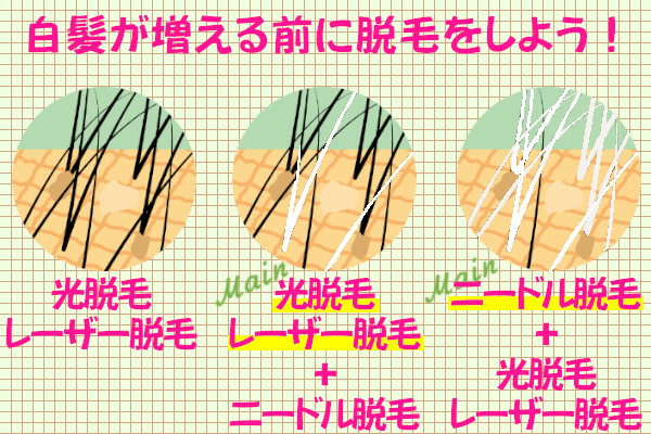 白髪が増えないうちに脱毛をスタートすることをおすすめ