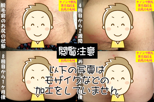 閲覧注意！ケノンで尻毛を脱毛してみた【男子高校生】