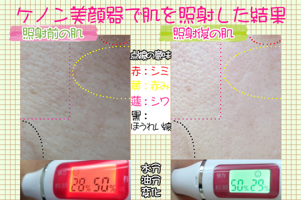 ケノン美顔器（スキンケア）で肌の乾燥・シワなど悩みを解消