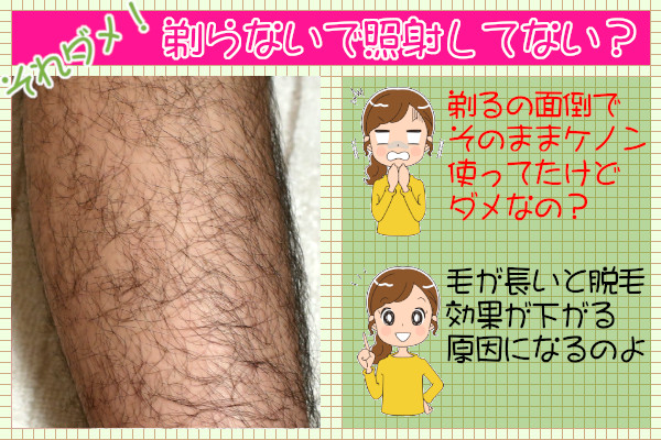 ケノンで効果を感じないときは・・ムダ毛を剃っていない